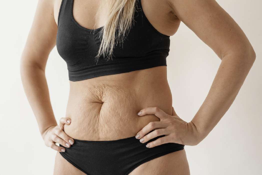 Things You Need To Know About The Mommy Makeover Surgery