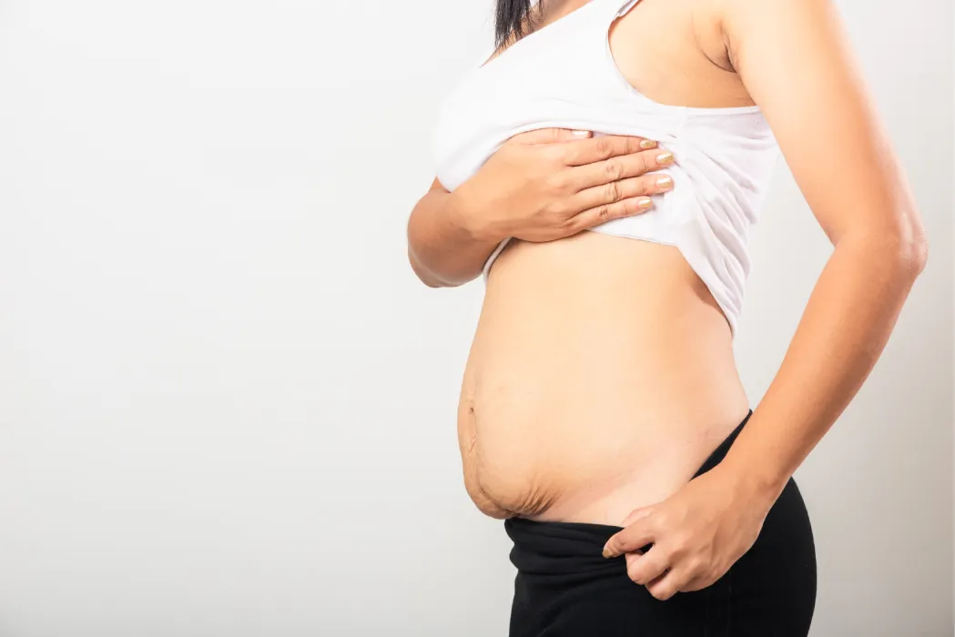 Body Contouring After Pregnancy: Restoring Your Pre-Baby Body