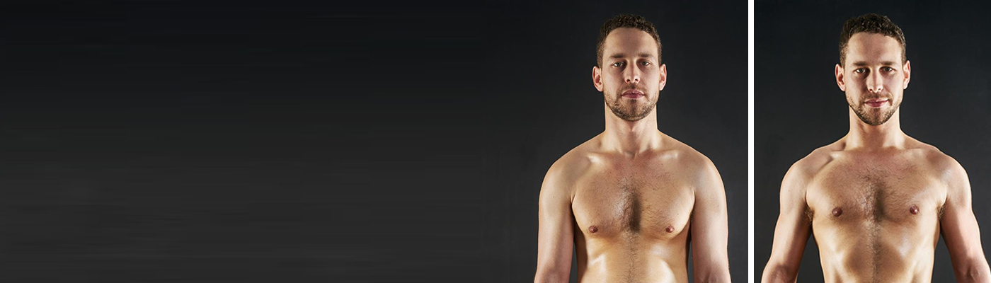 teenage gynecomastia