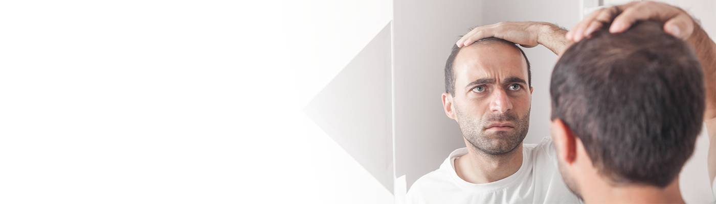 hair loss at 17 male