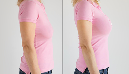 Breast Augmentation vs Fat Grafting: Which Looks More Natural?