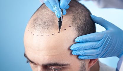 Hair Transplantation: Procedure, Methods, Recovery, and Expected Results