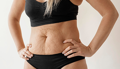 Why Stretch Marks Appear Even Without Pregnancy