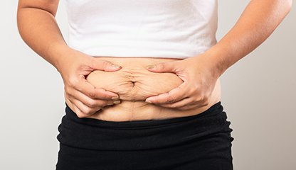 After Delivery My Stomach Is Loose – Can Surgery Fix This?