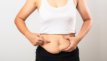 Loose Skin After Weight Loss: Why Liposuction Alone Isn’t Enough for Results