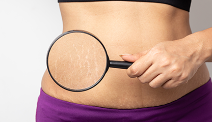 Stretch Marks When Skinny: Causes, Normal Signs & Treatment Options